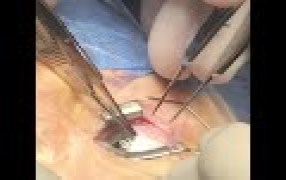 Guyton Small Incision Strabismus Hook
